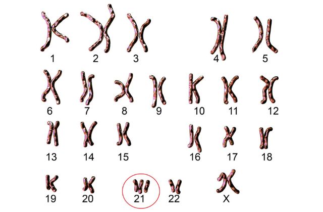 graphic representing trisomy 21 pattern of chromosomes for a individual with down syndrome.